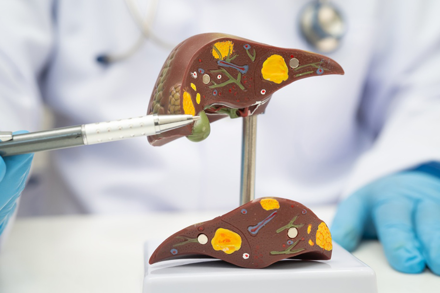 Fatty liver