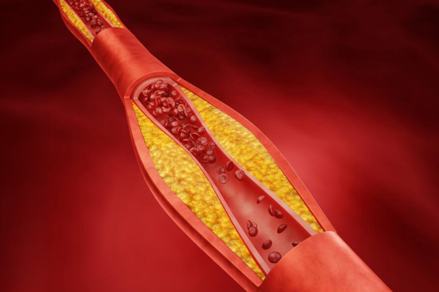 High cholesterol or triglycerides
